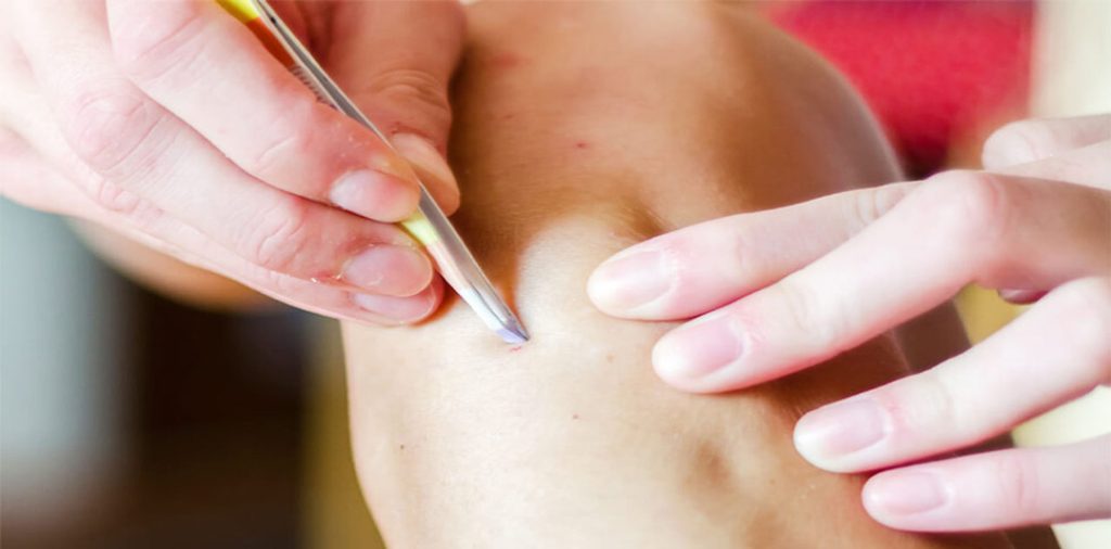 جوش و التهاب