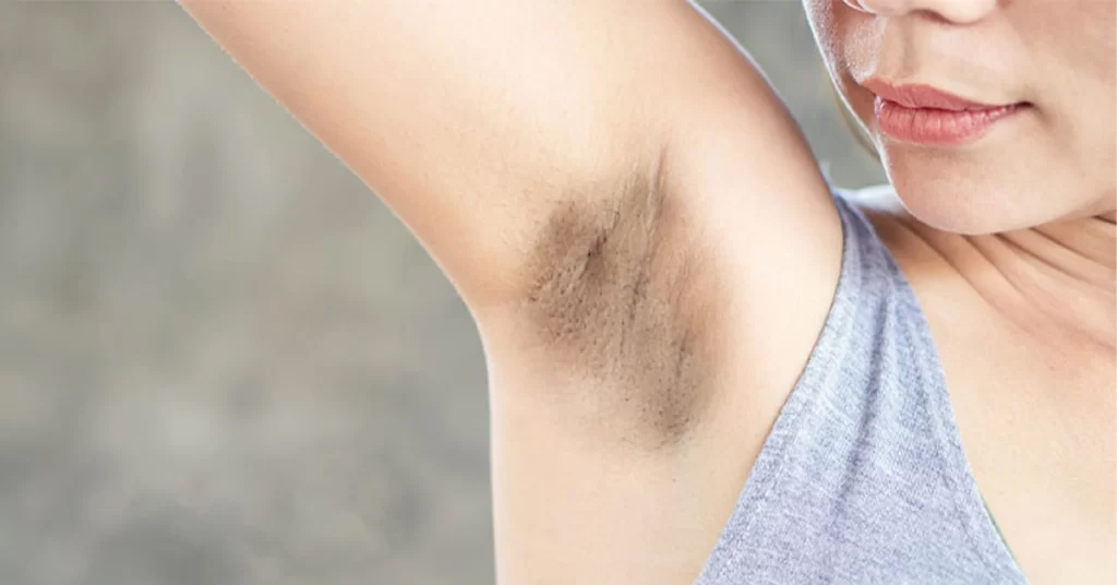 اصلاح موهای زائد