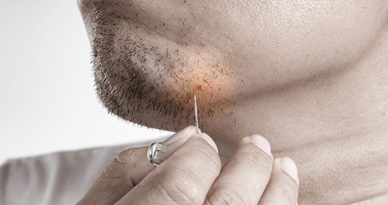 اصلاح موی زائد