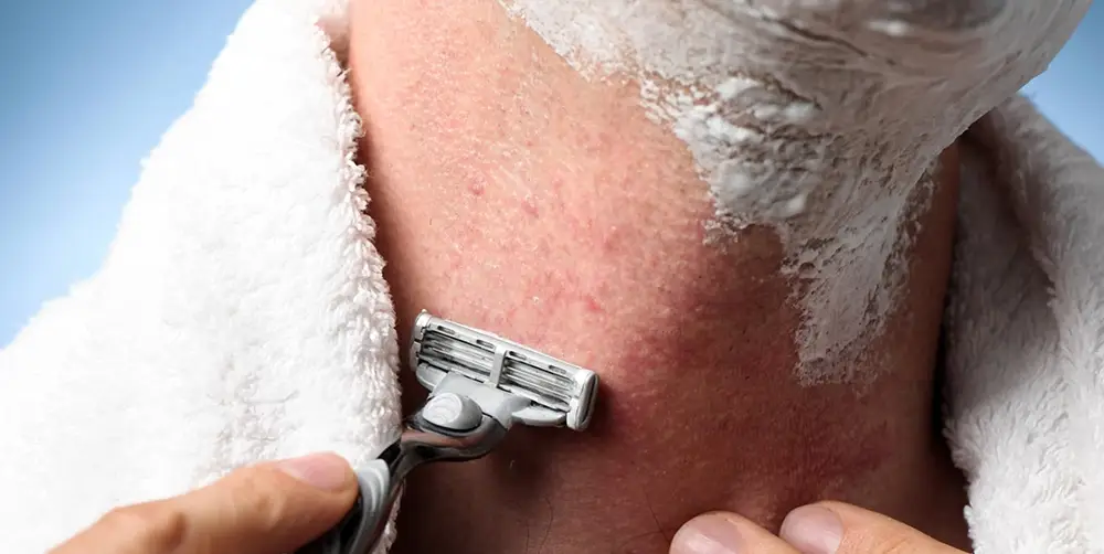 اصلاح موی زائد