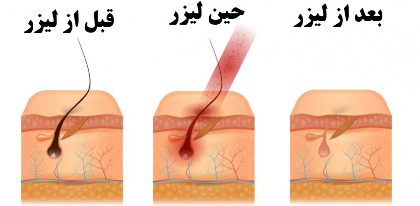 لیزر موهای زائد