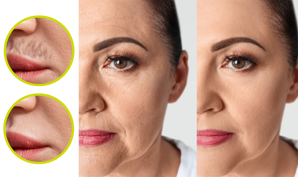 اصلاح موهای زائد